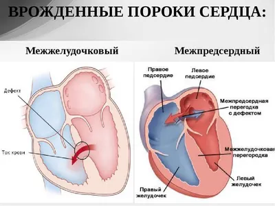 Врожденные пороки сердца