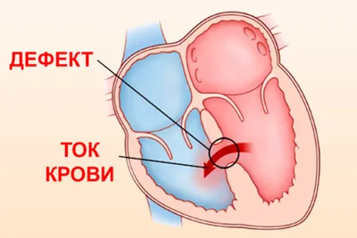 Порок сердца у новорожденных фото фото