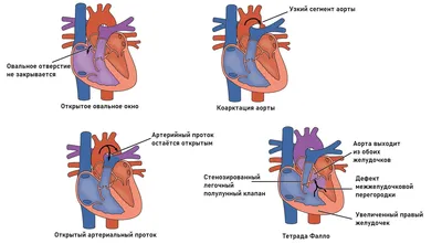 Краткий обзор врожденных сердечно-сосудистых аномалий (Overview of  Congenital Cardiovascular Anomalies) - Педиатрия - Справочник MSD  Профессиональная версия