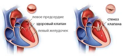 Лечение пороков сердца у новорожденных в Кыргызстане