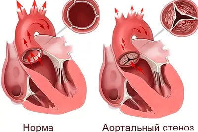 Порок сердца: у детей, новорожденных, симптомы, сколько живут