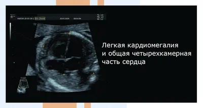 Скрининг новорожденных на критические врожденные пороки сердца в Грузии –  Rostropovich Vishnevskaya Foundation