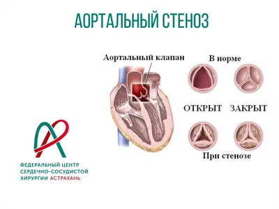 Пороки сердца - причины появления, симптомы заболевания, диагностика и  способы лечения