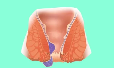 Наружный геморрой - причины и методы лечения