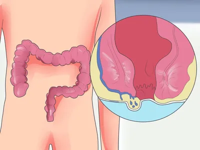 Наружный геморрой - причины и методы лечения