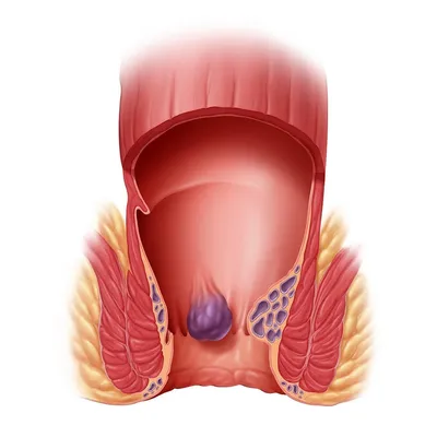 Наружный геморрой - причины и методы лечения