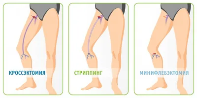 Восстановление после операции по удалению варикоза — особенности  реабилитации после операции