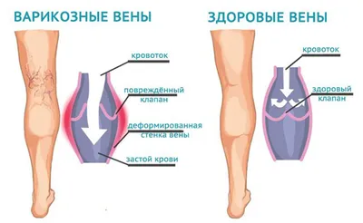 Минифлебэктомия. Отзывы о минифлебэктомии. Цены на операцию минифлебэктомии.