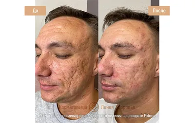 Результат комплексного лечения акне✨ ✨ Врач-косметолог, дерматовенеролог  Деревнина Анастасия @neastasya ✓Были проведены следующие… | Instagram