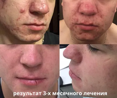 Клиника лечения угрей и реабилитации кожи в Москве - прием дерматолога:  удаление прыщей, акне, лечение постакне.