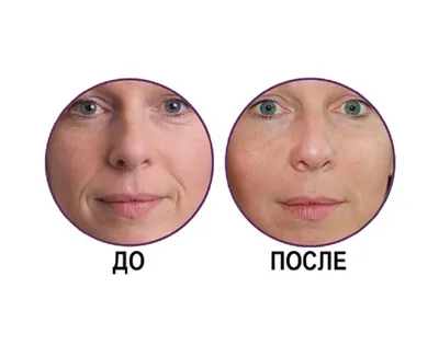 Ботулинотерапия в СПБ - введение ботокса от морщин на лице в клинике  косметологии Gynecolase