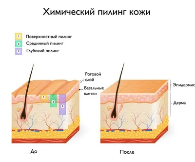 Последствия после пилинга | Косметология и эстетическая медицина | Дзен