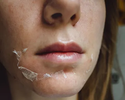 Химические пилинги лица в Оренбурге: второе дыхание для вашей кожи