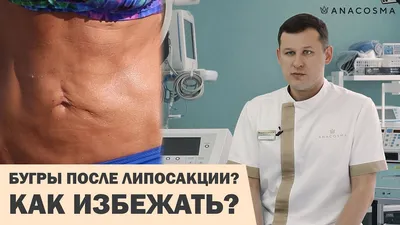 БУГРЫ, НЕРОВНОСТИ ПОСЛЕ ЛИПОСАКЦИИ ⛔️ ЧТО ДЕЛАТЬ ❓ - YouTube