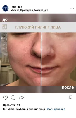 Пилинги | Di-Beauty Косметологический Центр в Энгельсе