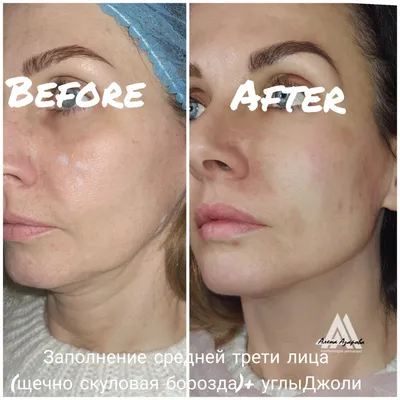 Липофилинг лица собственным жиром в Киеве - Coolaser Clinic