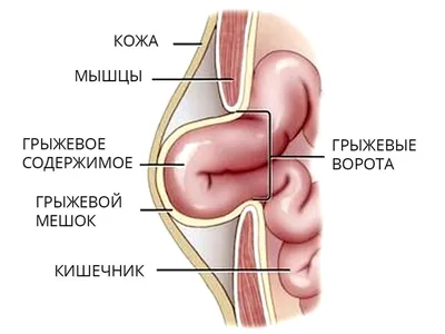 Послеоперационная грыжа: лечение, пластика, операция по удалению в СПб -  цена