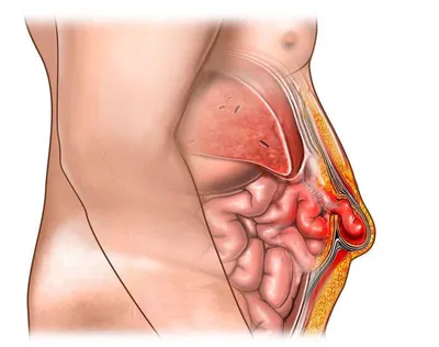 Удаление послеоперационной грыжи на животе, цена в Москве, сделать операцию  в центре Открытая Клиника