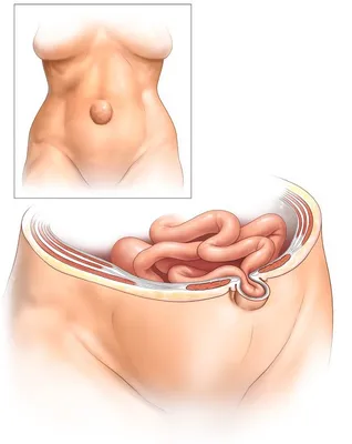 Операция при грыже передней брюшной стенки