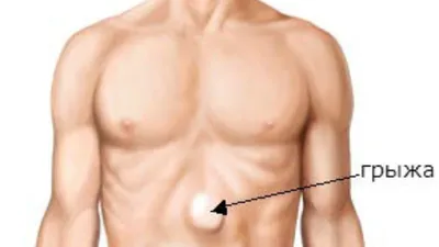 Грыжа белой линии живота у ребенка: основные аспекты, рекомендации врачей и  методы лечения