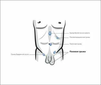 Послеоперационная грыжа - лечение по ОМС