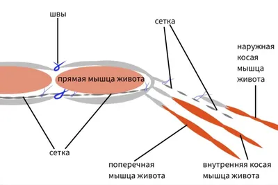 Протезирующая пластика брюшной стенки в лечении вентральных и послеоперационных  грыж: классификация, терминология и технические аспекты (обзор) – тема  научной статьи по клинической медицине читайте бесплатно текст  научно-исследовательской работы в ...