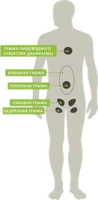 Грыжа белой линии