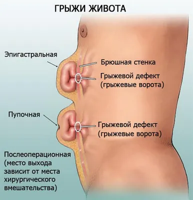 Лечение послеоперационных грыж в Москве | Егиев В.Н.