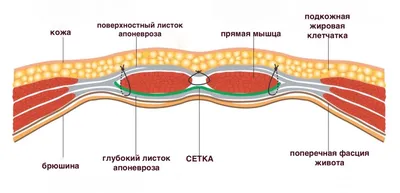 Послеоперационная грыжа живота: лечение вентральной грыжи