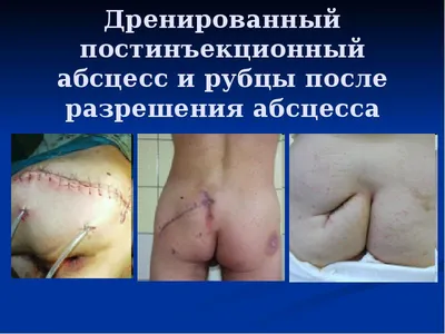 Флебит вены на руке после катетера: лечение постинъекционного тромбофлебита  — phlebo1.ru