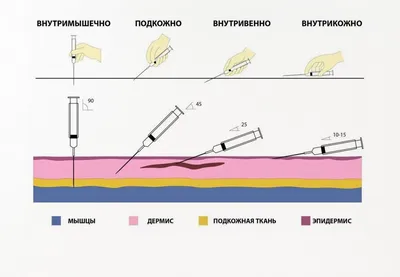 Флебит: вен, нижних конечностей, лечение, диагностика