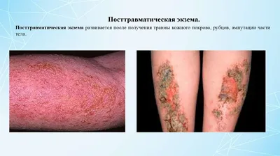 Лечение Экземы - Дерматолог в Киеве- Альтернатива МЦ