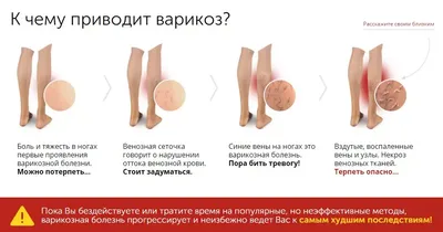 Хронические заболевания вен | Sigvaris.com