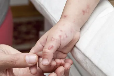 Pediatric outpatient clinic - Отрубевидный (разноцветный) лишай (Pityriasis  versicolor, альт. — Tinea versicolor) Бытовое название:«солнечный грибок».  Очень часто появление этого заболевания замечают после пребывания на  солнце. Разноцветный лишай ...