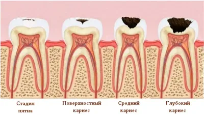 Лечение глубокого кариеса - детская стомалогия Nikadent Family