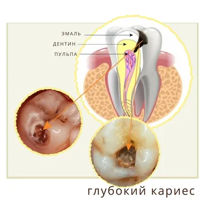 Лечение кариеса: стоимость, виды, симптомы | стоматология Нардент(МСК)