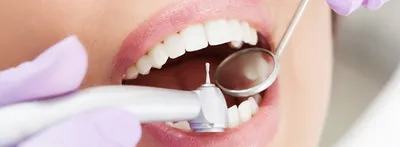 Лечение поверхностного кариеса зубов в «Бюджетной стоматологии»