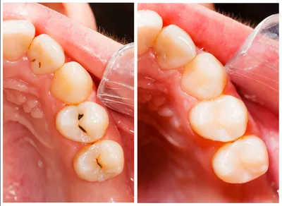 Лечение кариеса зубов, цена в Московской клинике