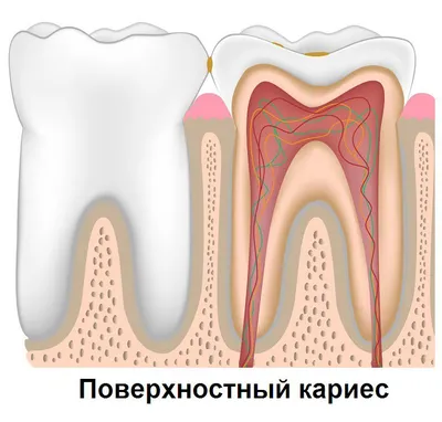 Глубокий кариес зубов – симптомы, лечение в Москве – цены, отзывы в  стоматологических клиниках Зуб.ру