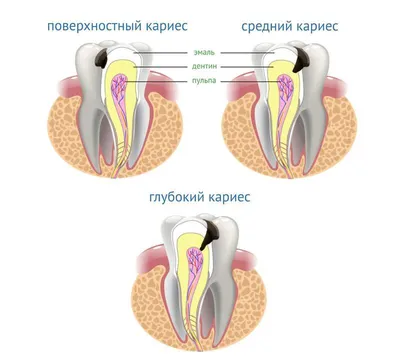 Лечение кариеса в Сургуте