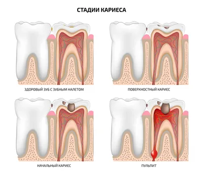 Кариес у детей (лечение в Киеве, цены) - фото, причины