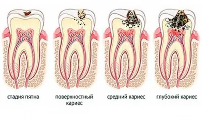 Пришеечный кариес. Диагностика, лечение, профилактика, стадии...