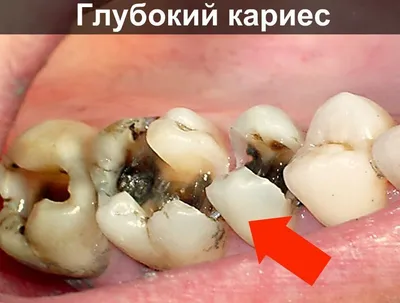 Кариес передних зубов | Стоматология в Красноярске \"ВОКА\" -  стоматологическая клиника