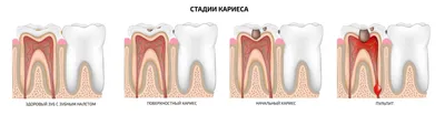 Начальный кариес: лечение, фото, диагностика | Интернет-журнал  Estetmedicina.ru