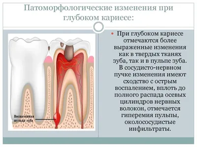 Поверхностный кариес зубов
