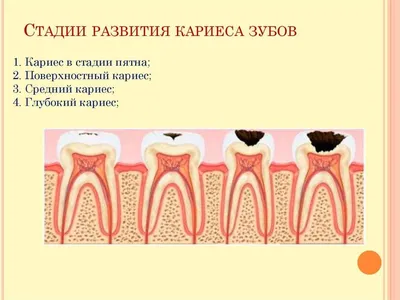 Поверхностный кариес — лечение и диагностика ❘ Стоматология Ортодонт  Комплекс