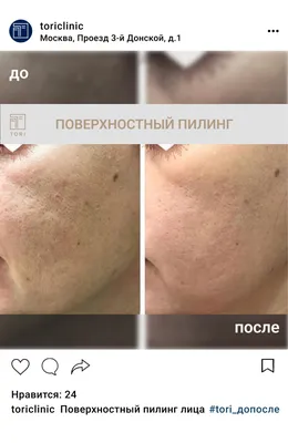Поверхностный пилинг лица и кожи, цены в Москве