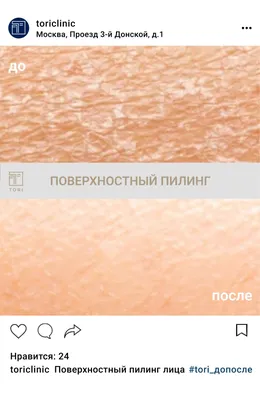 Химические пилинги лица в Санкт-Петербурге — БИОМЕД