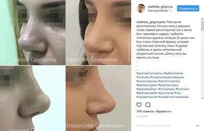 7. Вторичная ринопластика, особенности, факты и примеры — NOSE.AM —  профессиональная ринопластика