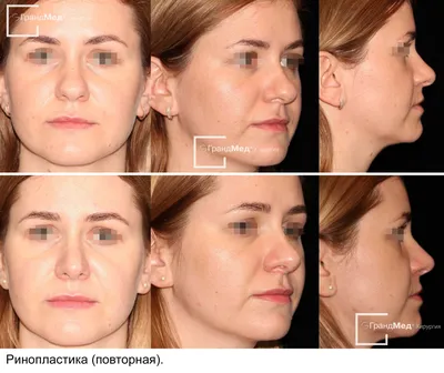 Ринопластика носа в Саратове по доступной цене